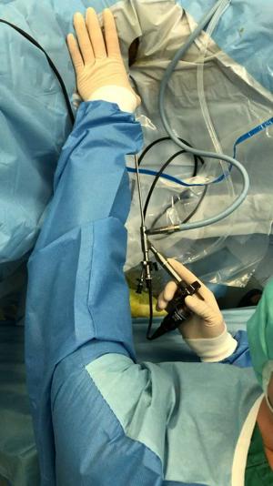 北大泌尿王刚教授讲解输尿管硬镜的特点